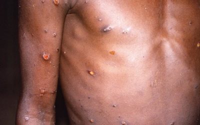 Contipharma lance un test de détection du Mpox